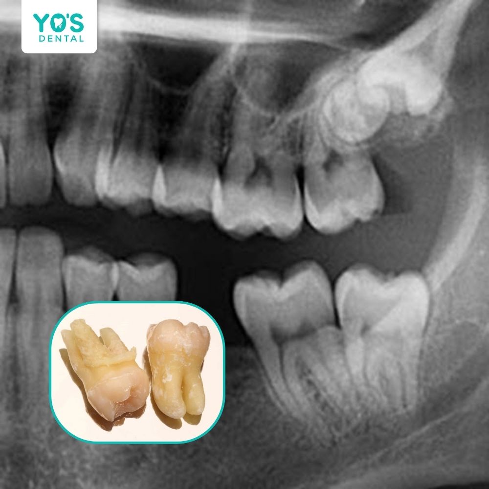Chân răng khôn là yếu tố quyết định độ khó của ca nhổ răng