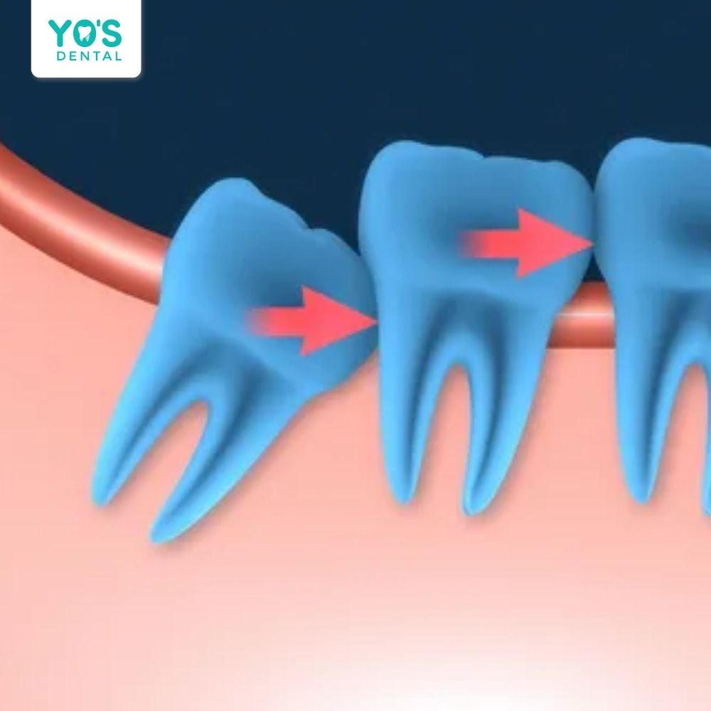 Răng khôn mọc lệch gây lực đẩy các răng kế bên làm sai khớp cắn