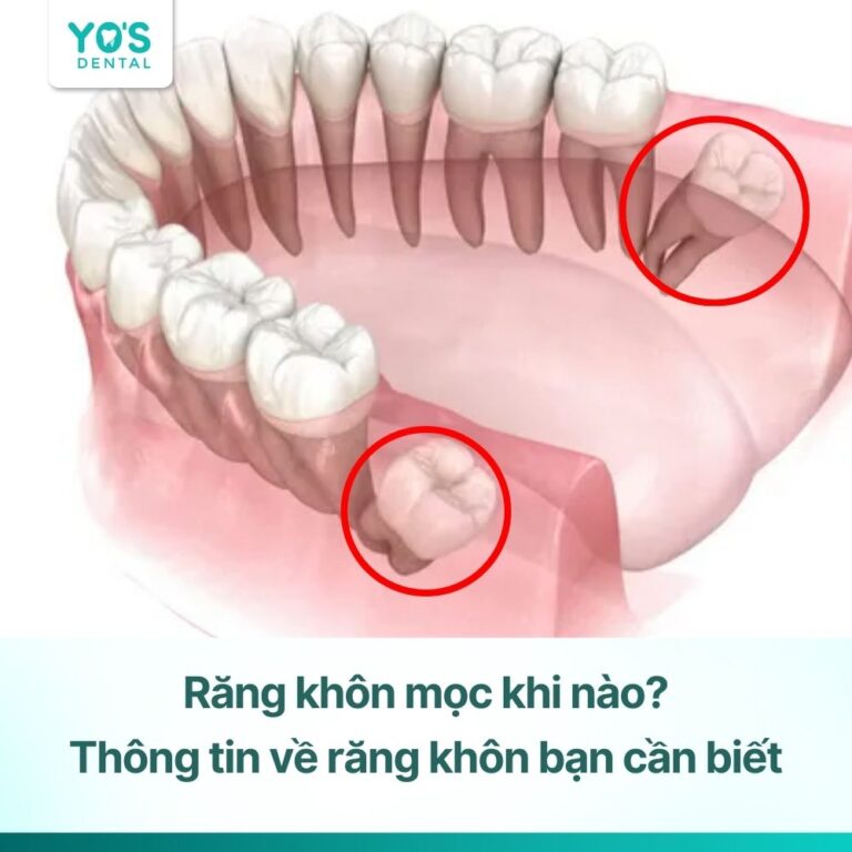 Răng khôn mọc khi nào? Toàn bộ thông tin về răng khôn bạn cần biết