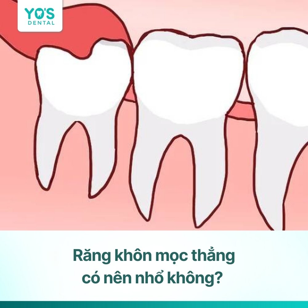 Răng khôn mọc thẳng có nên nhổ? Giải đáp chi tiết từ nha sĩ