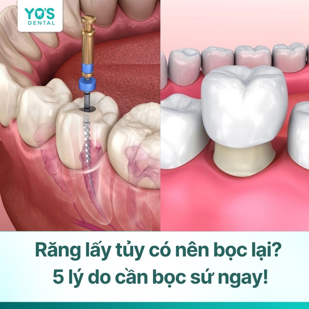Răng lấy tủy có nên bọc lại? 5 lý do cần bọc sứ ngay!