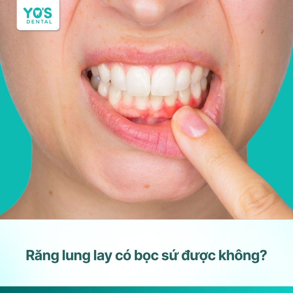 Răng lung lay có bọc sứ được không? Chuyên gia Nha khoa Yo's Dental giải đáp