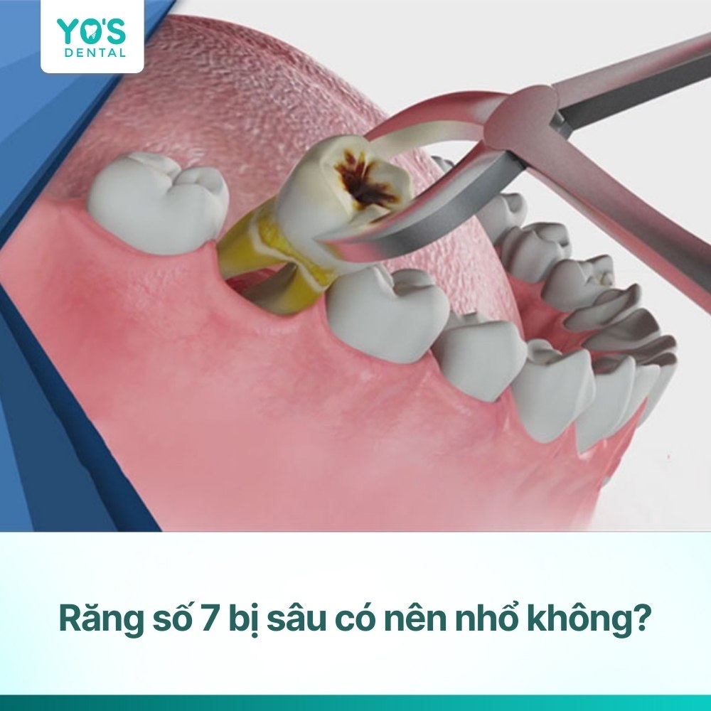 Răng số 7 bị sâu có nên nhổ không? Các lưu ý cần biết