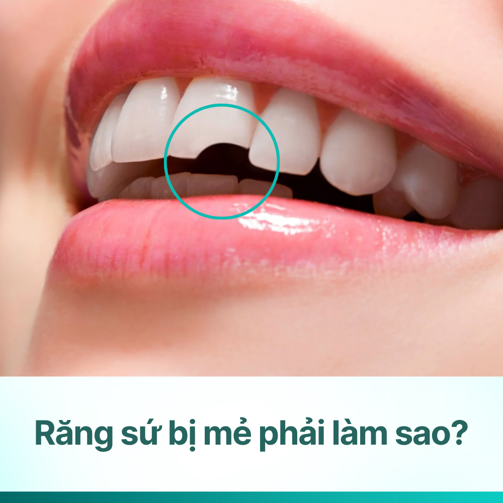Răng sứ bị mẻ phải làm sao? Giải pháp và cách phòng ngừa hiệu quả