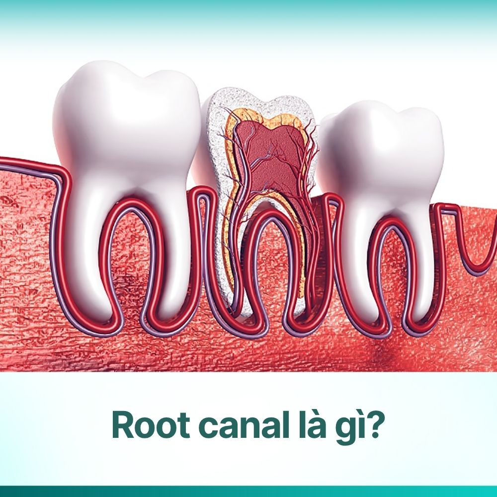 Root canal là gì? Giải mã quy trình điều trị tủy răng tại Yo's Dental