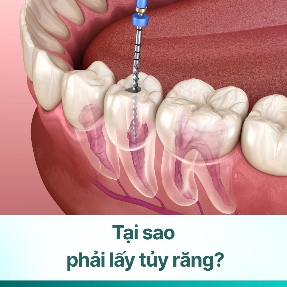 Tại sao phải lấy tủy răng và các dấu hiệu nhận biết sớm