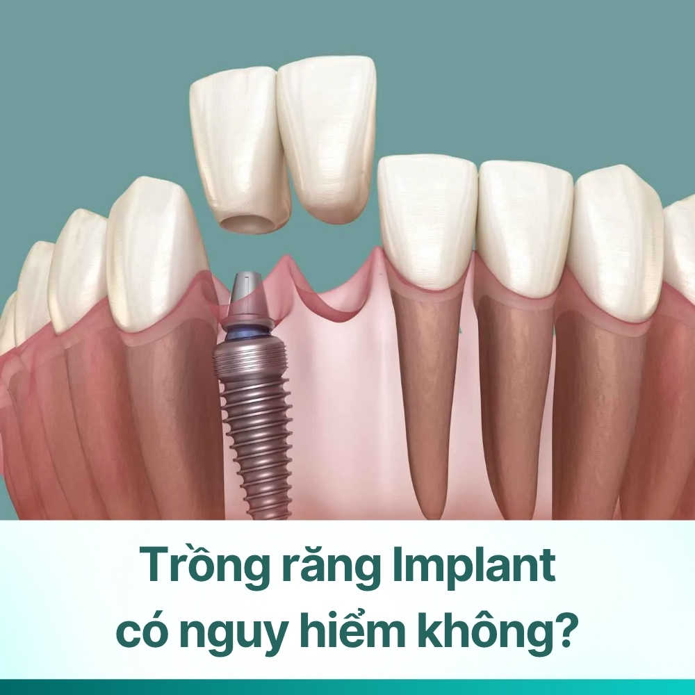 Trồng răng Implant có nguy hiểm không? Lợi và hại nên biết