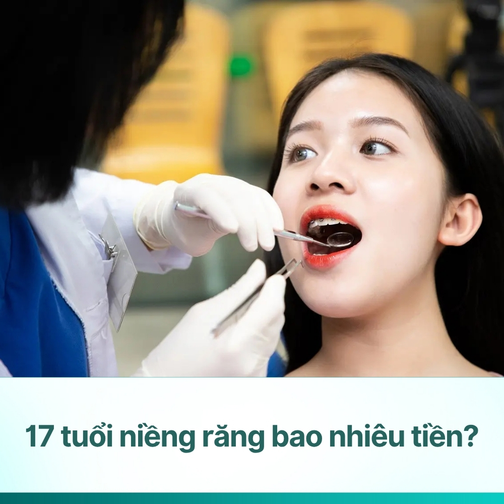 17 tuổi niềng răng bao nhiêu tiền? Chi phí & bí quyết niềng hiệu quả