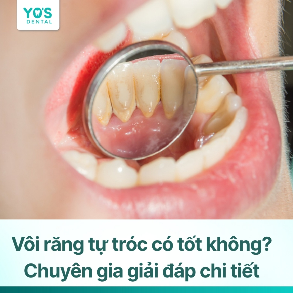 Vôi răng tự tróc có tốt không? Chuyên gia giải đáp chi tiết