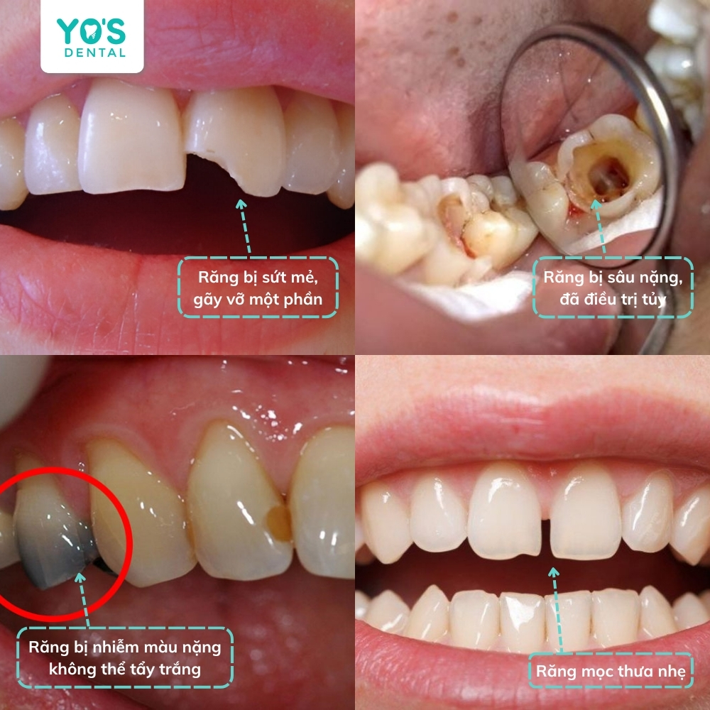 Răng sứ khắc phục hiệu quả các vấn đề như sứt mẻ, sâu lớn, nhiễm màu nặng hoặc thưa nhẹ.