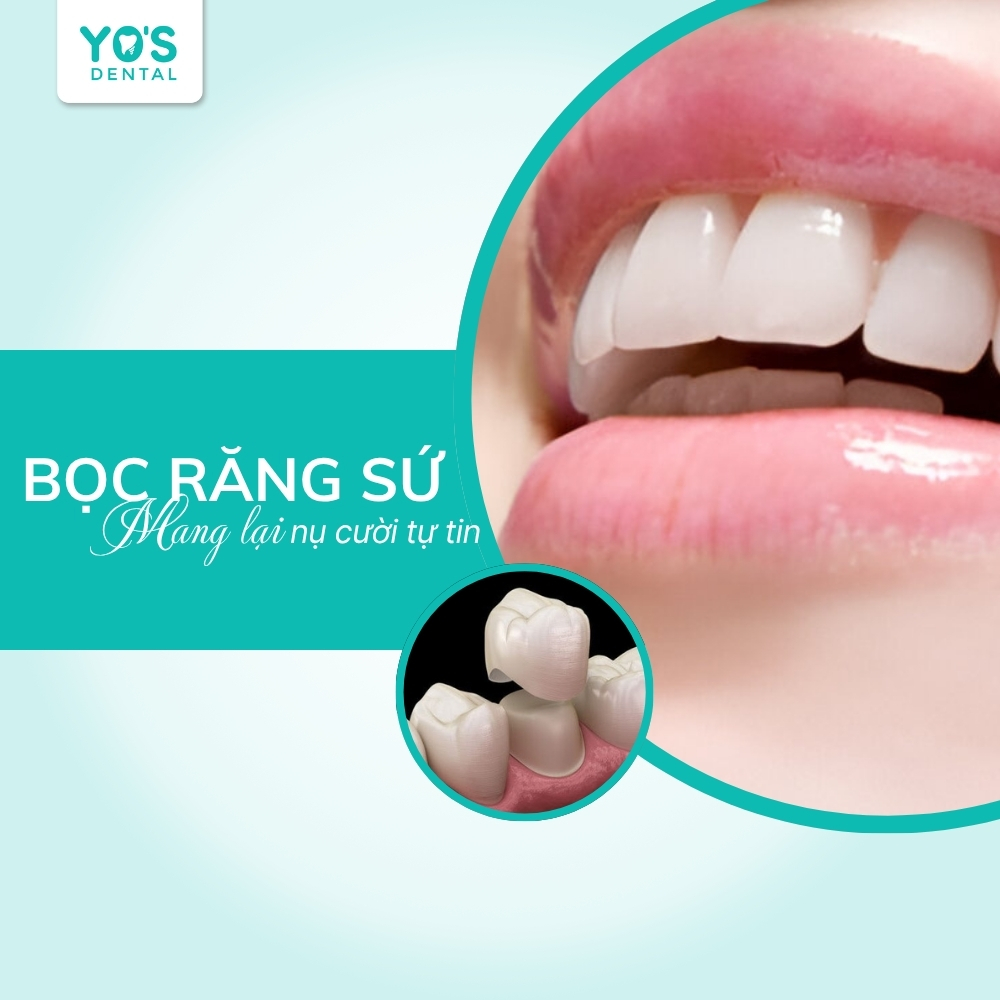 Bọc răng sứ mang lại nụ cười tự tin và hài hòa cho khuôn mặt