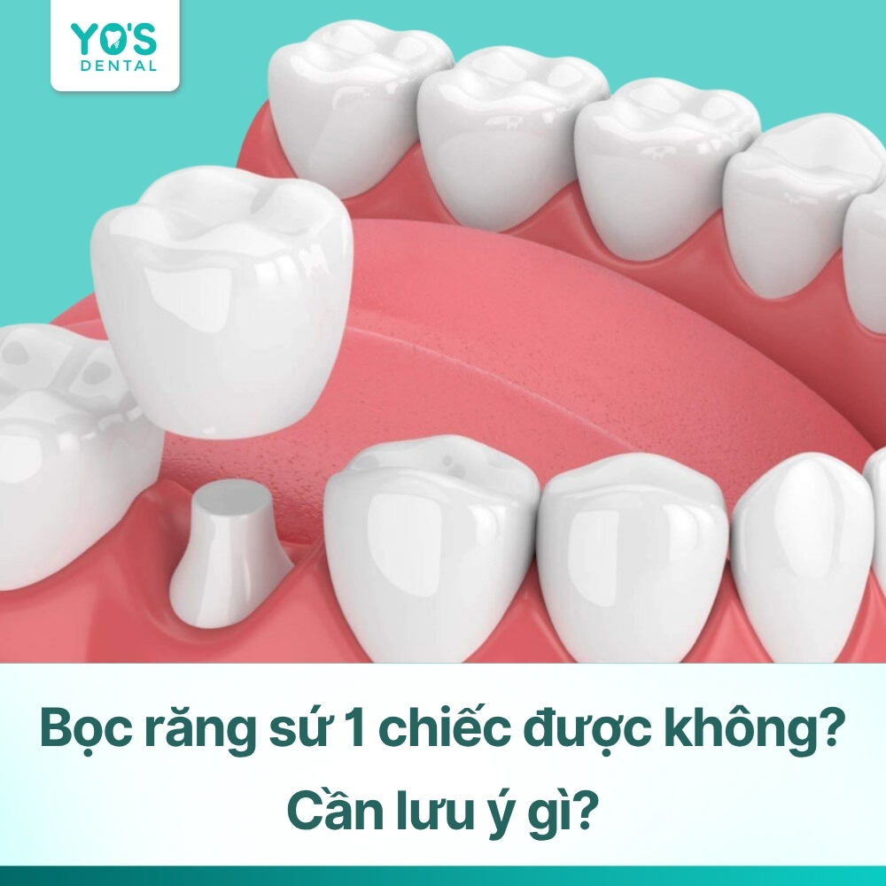 Bọc răng sứ 1 chiếc được không? Cần lưu ý gì?