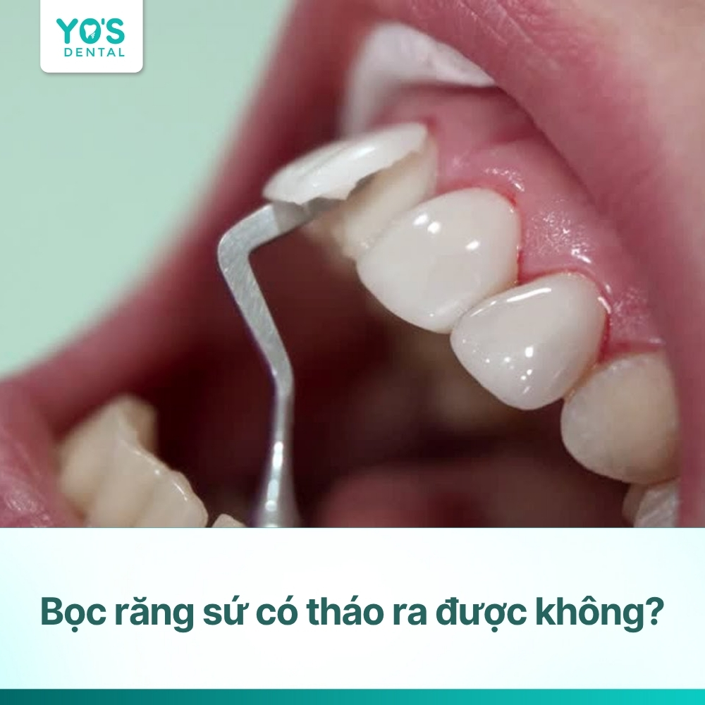 Bọc răng sứ có tháo ra được không? Lắp lại được không?