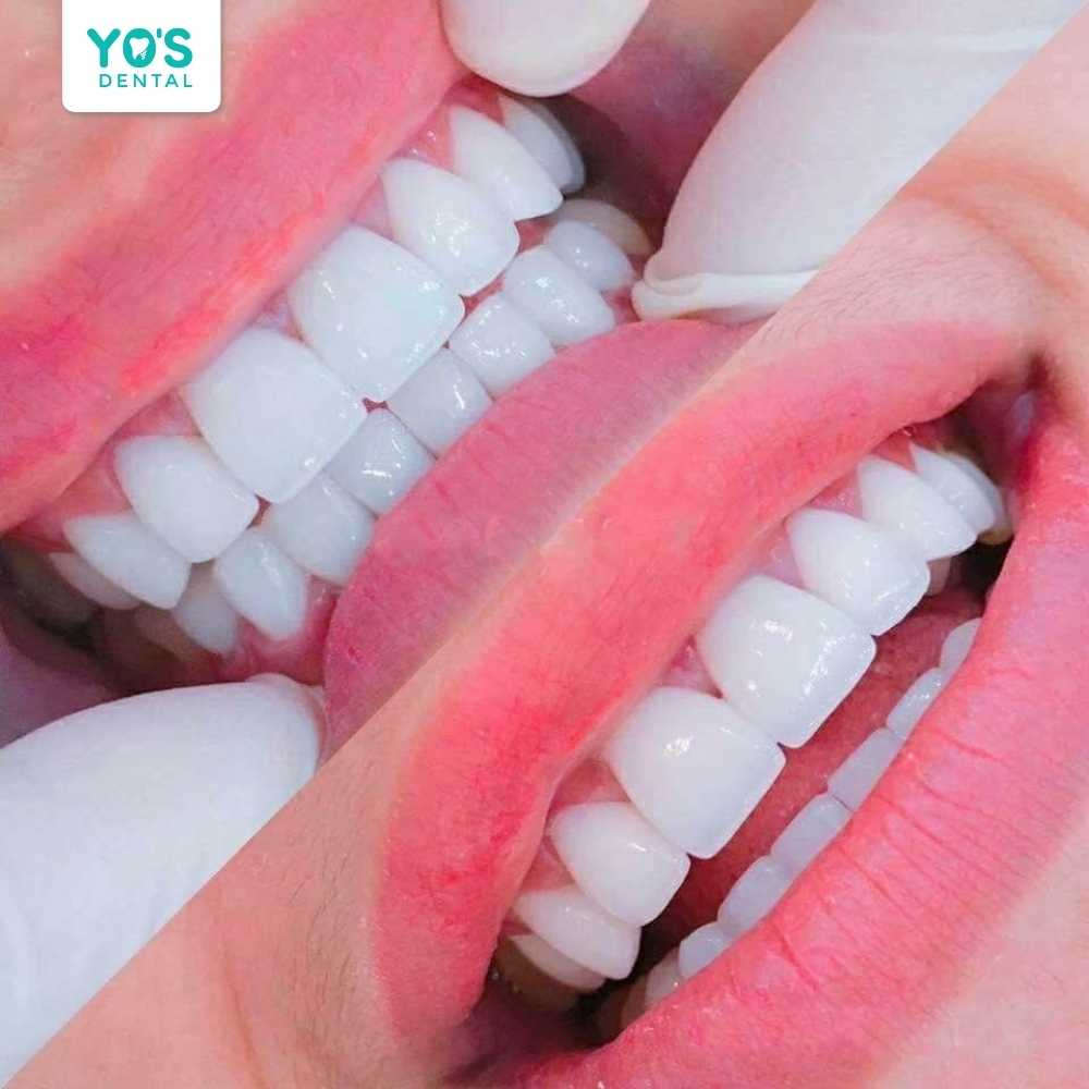 Bọc răng sứ kiến tạo nụ cười trắng sáng và rạng rỡ đầy tự tin.