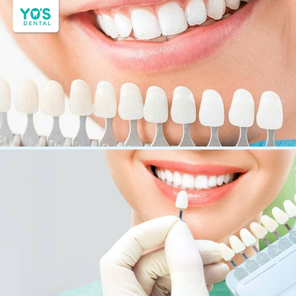 Mỗi dáng răng sứ mang đến một vẻ đẹp và cá tính riêng biệt.