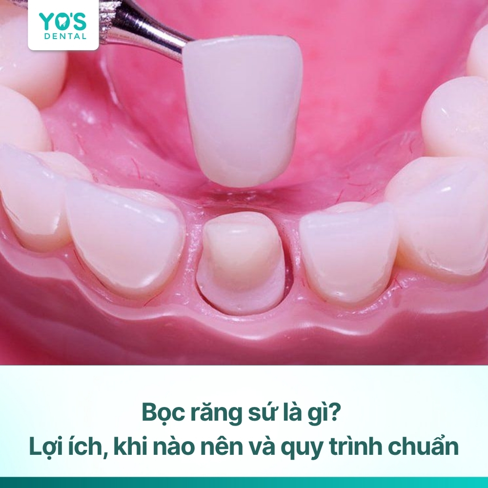 Bọc răng sứ là gì? Lợi ích, khi nào nên và quy trình chuẩn