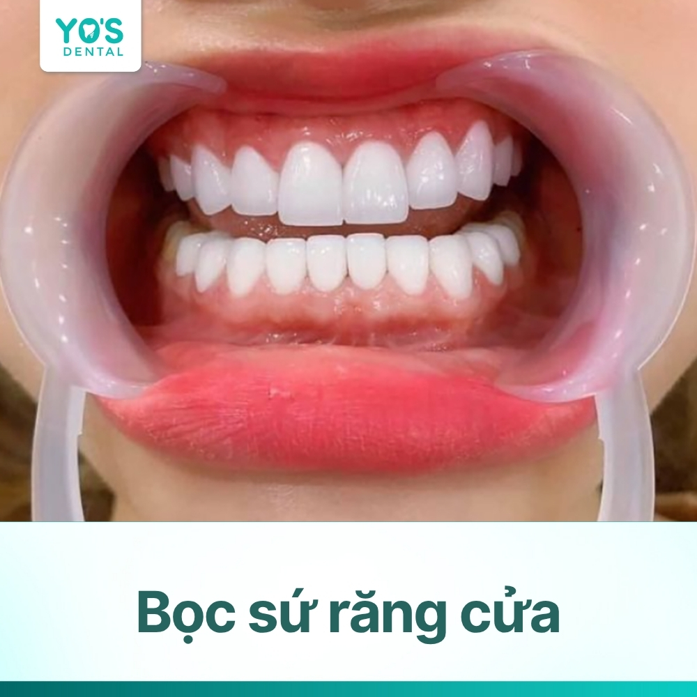 Bọc sứ răng cửa: Chi phí, quy trình & những điều cần biết