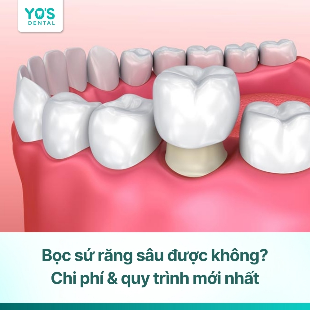 Bọc sứ răng sâu được không? Chi phí & quy trình mới nhất