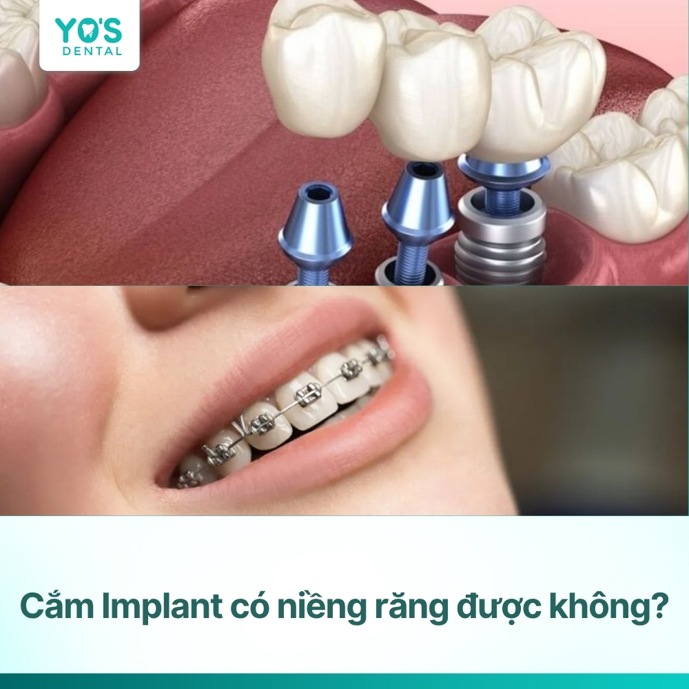 Cắm Implant có niềng răng được không? Giải đáp toàn diện A-Z