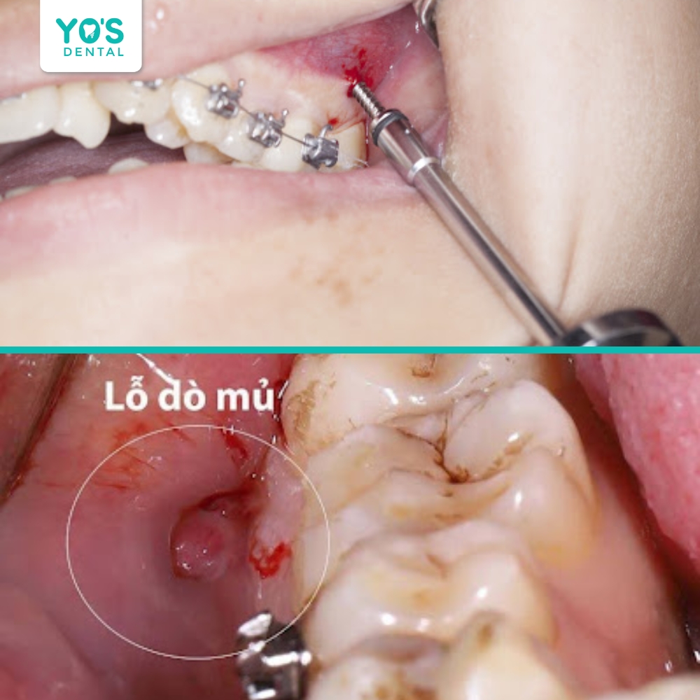 Vệ sinh kém có thể gây viêm nhiễm xung quanh vít niềng răng.