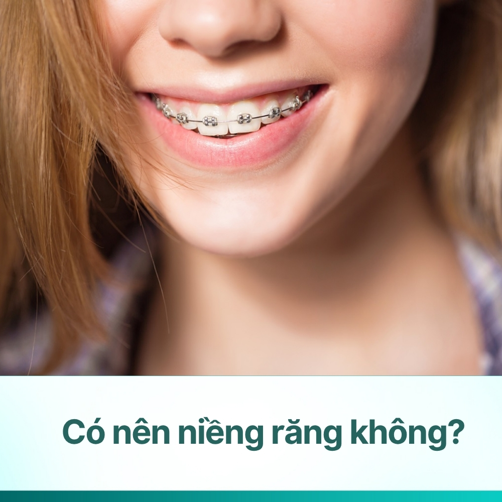 Có nên niềng răng không? Ưu, nhược điểm & lời khuyên từ bác sĩ