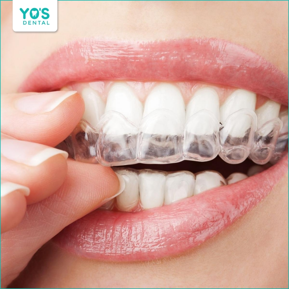 Niềng răng Invisalign mang lại độ thẩm mỹ cao nhưng chi phí đắt đỏ
