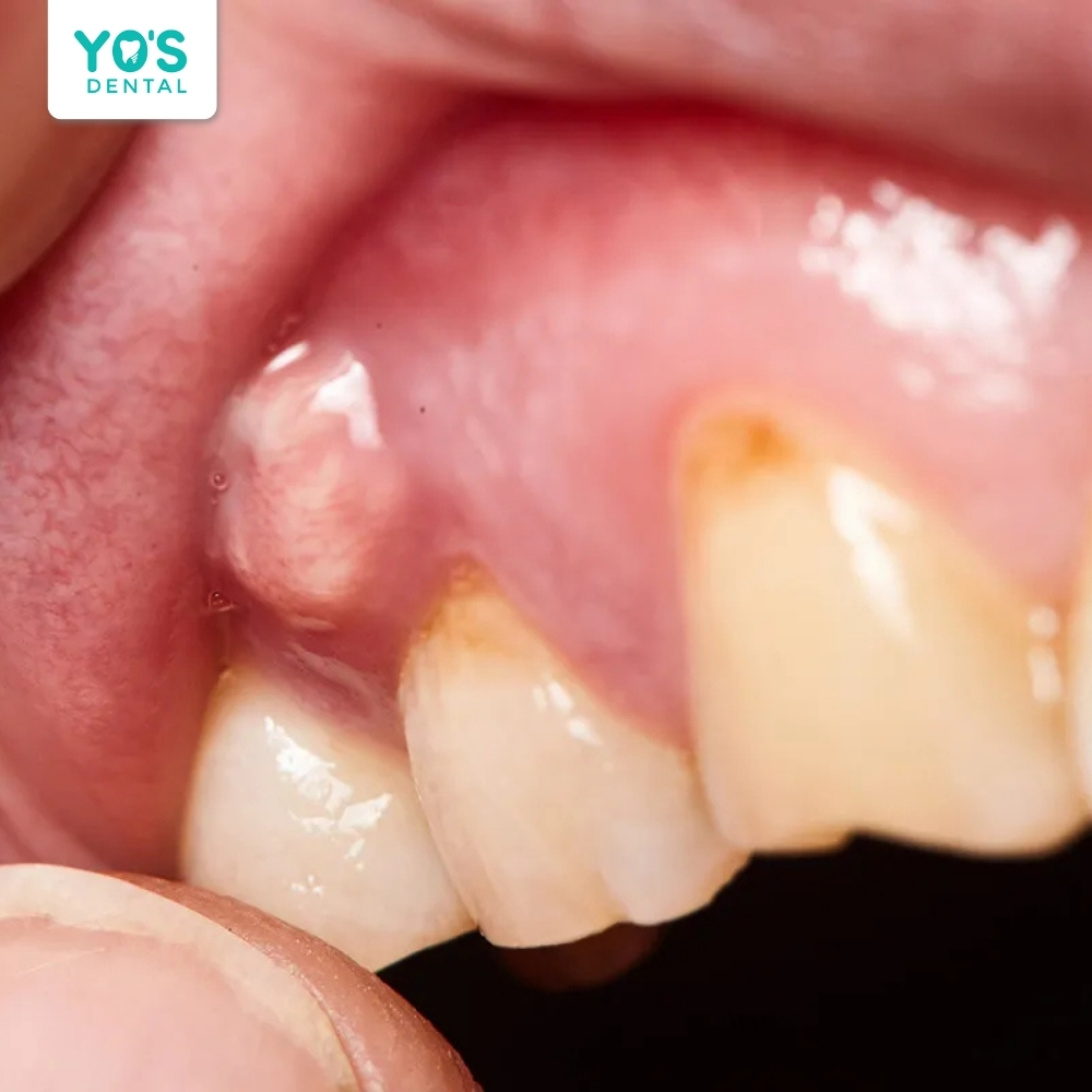 Tình trạng áp xe ở chóp răng không thể bọc sứ
