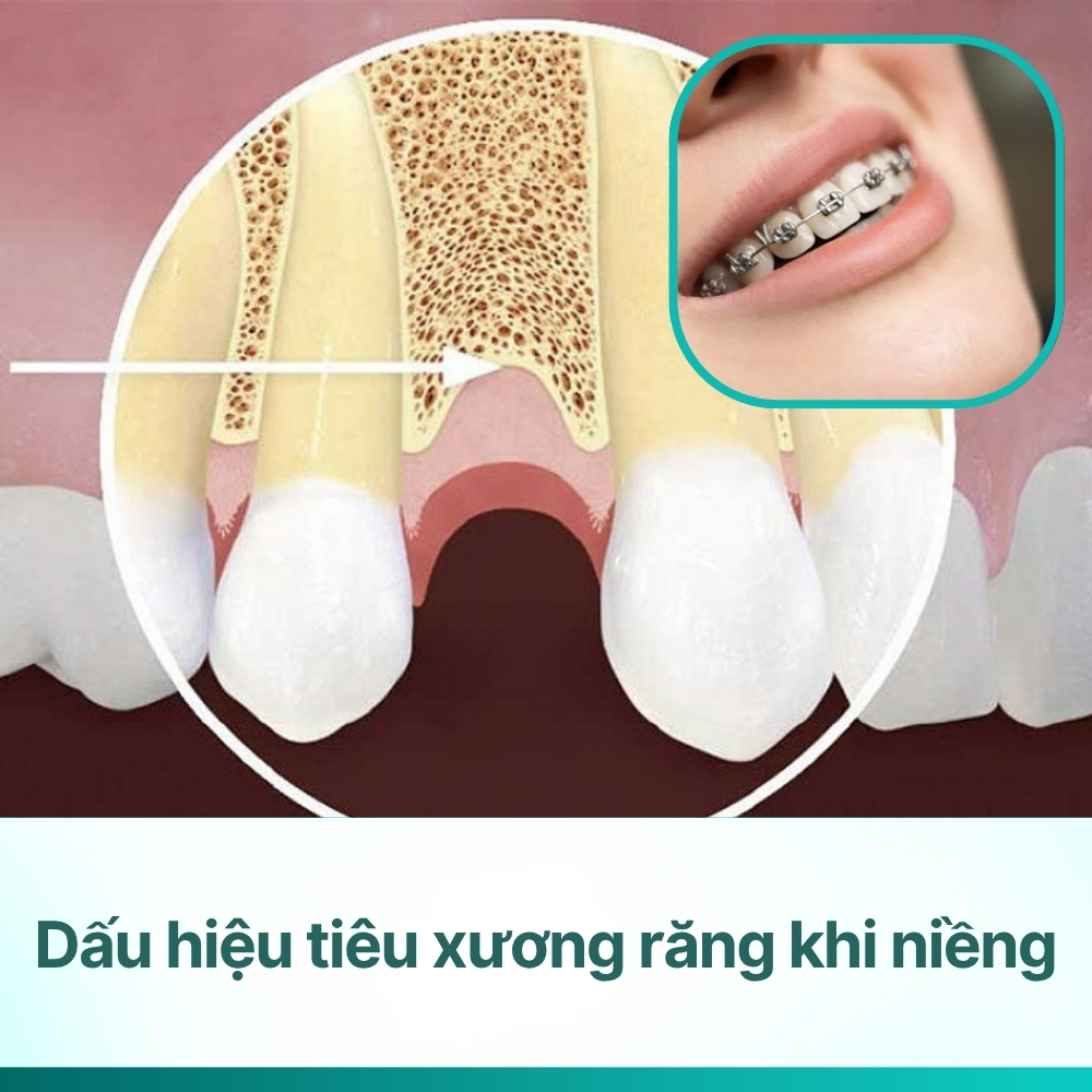 Dấu hiệu tiêu xương răng khi niềng: Nguyên nhân và cách khắc phục