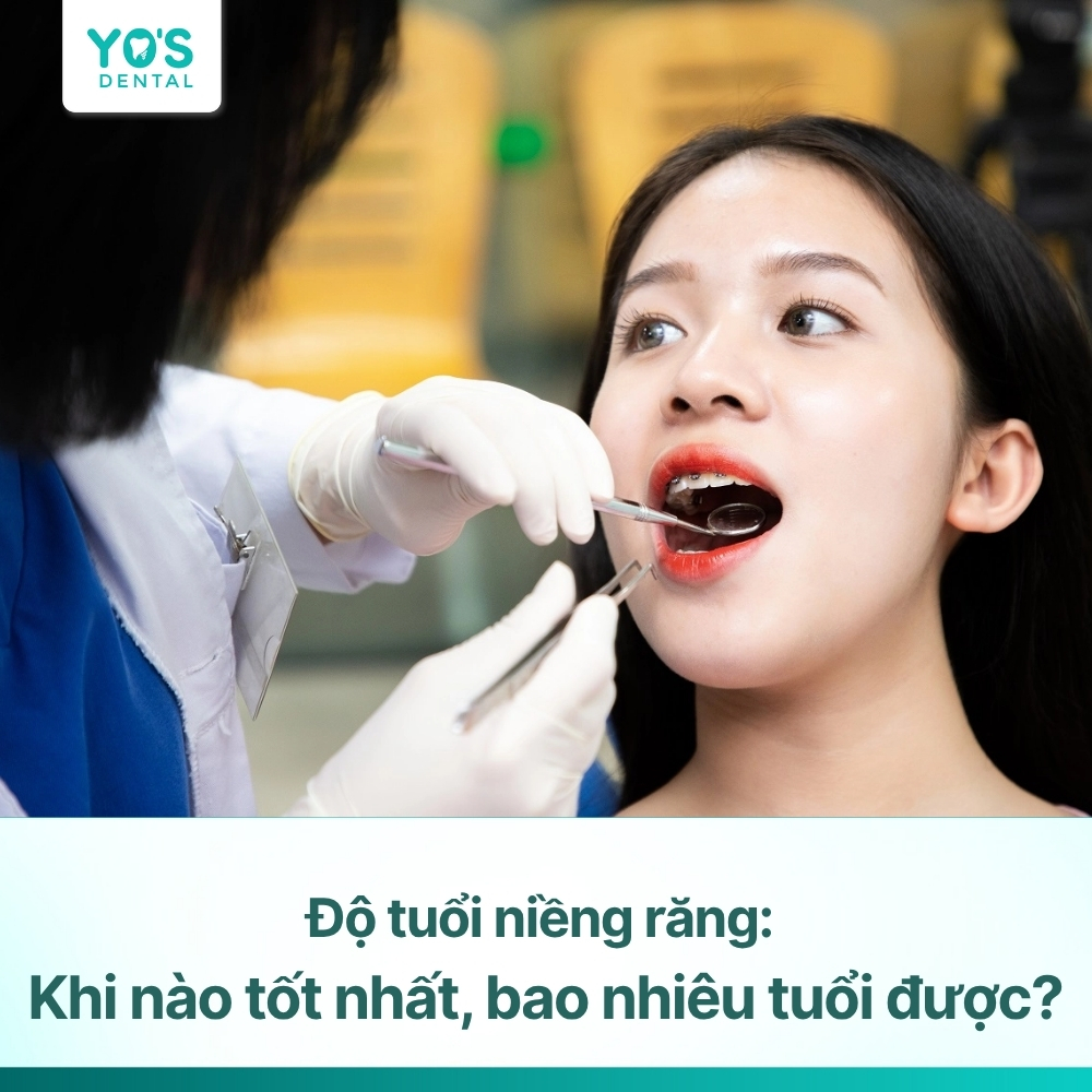 Độ tuổi niềng răng: Khi nào tốt nhất, bao nhiêu tuổi được?