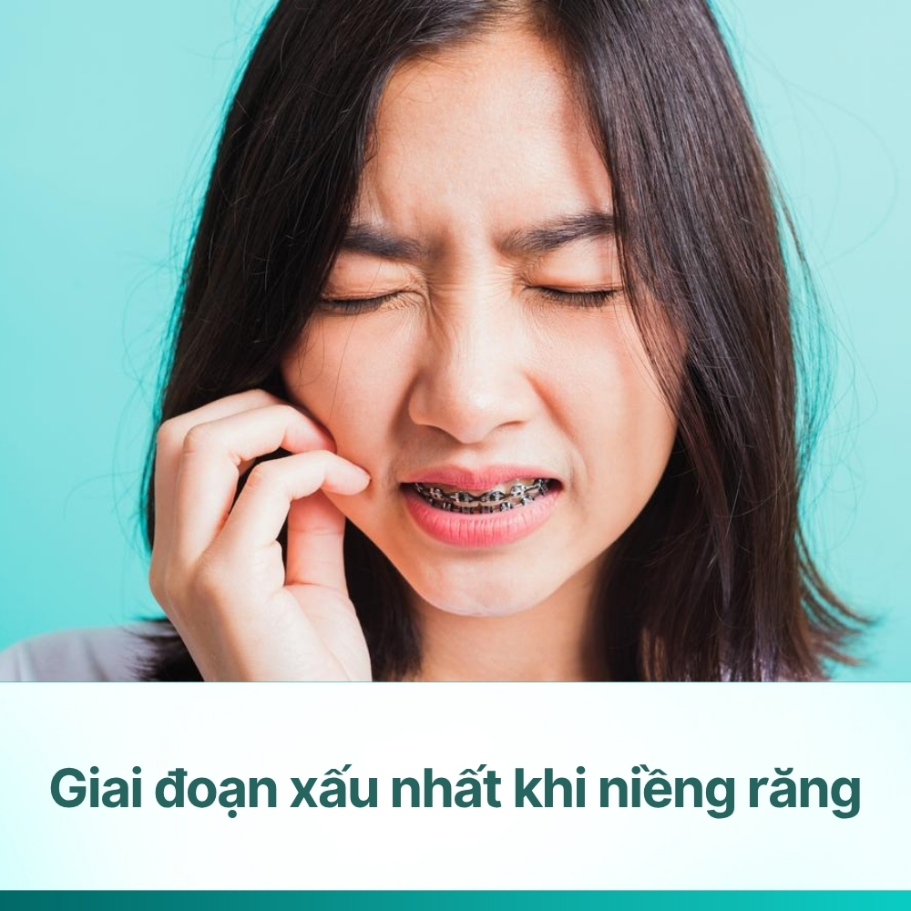 Giai đoạn xấu nhất khi niềng răng: Nhận diện và vượt qua nỗi lo