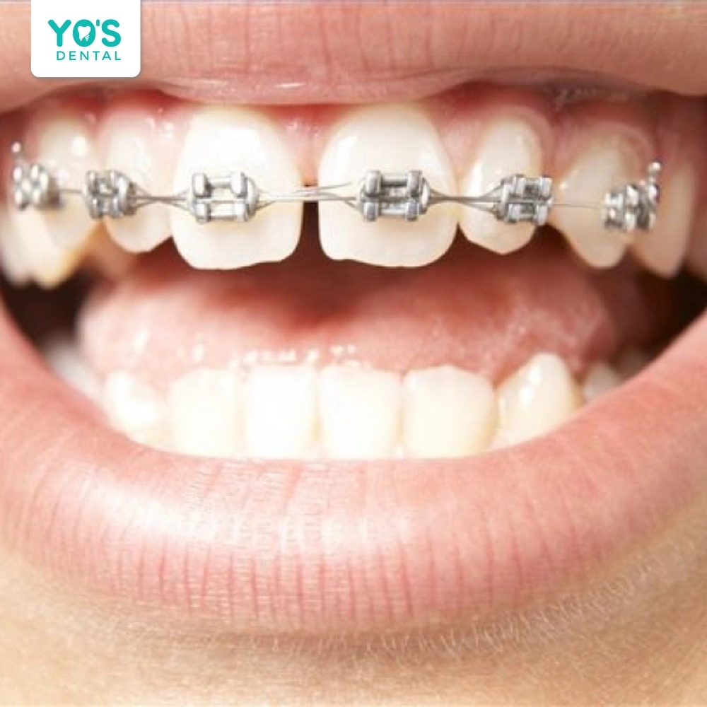 Xuất hiện khe thưa răng trong quá trình niềng khiến nụ cười trông kém tự tin