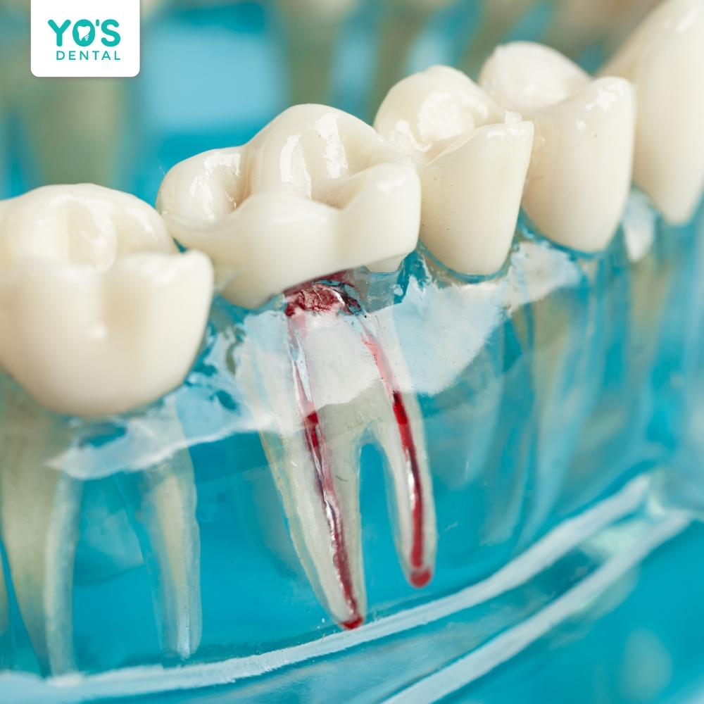 Tuổi thọ của chiếc răng chữa tủy có thể duy trì 15 – 25 năm.