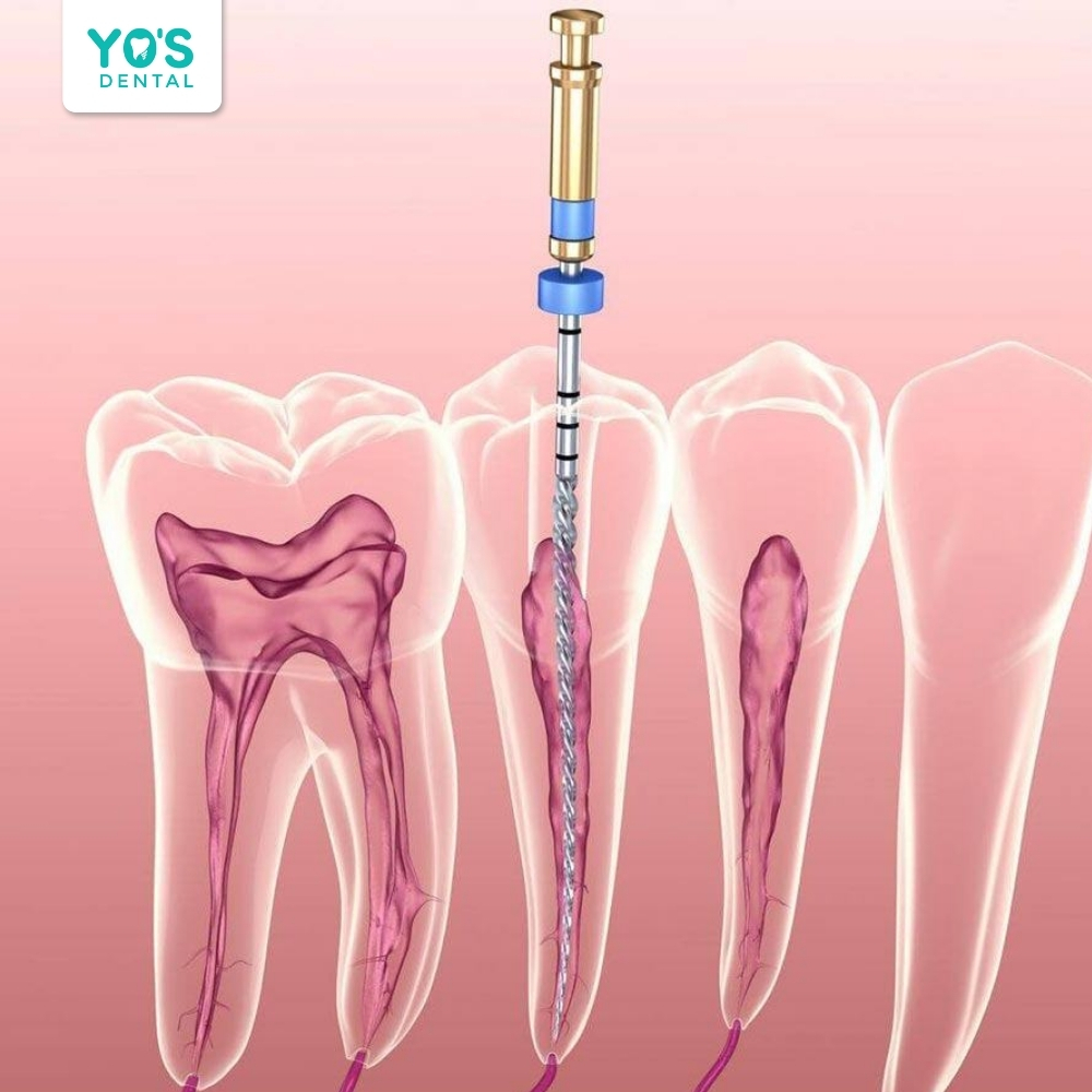 Việc lấy tủy nhiều lần giúp làm sạch triệt để hệ thống ống tủy phức tạp.