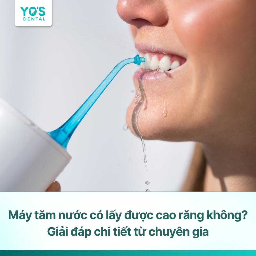 Máy tăm nước có lấy được cao răng không? Giải đáp chi tiết từ chuyên gia
