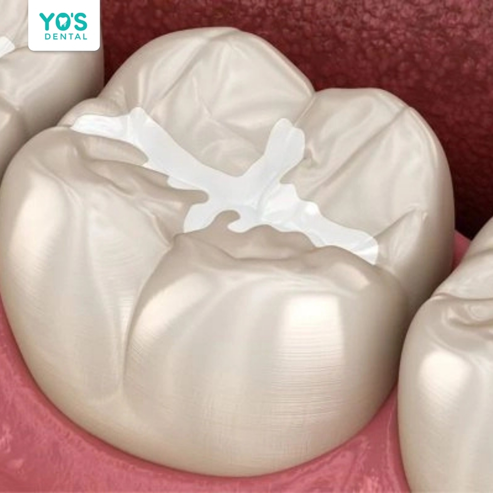 Cần kiêng ăn uống trong 2 giờ đầu sau khi trám răng đối với vật liệu Composite 