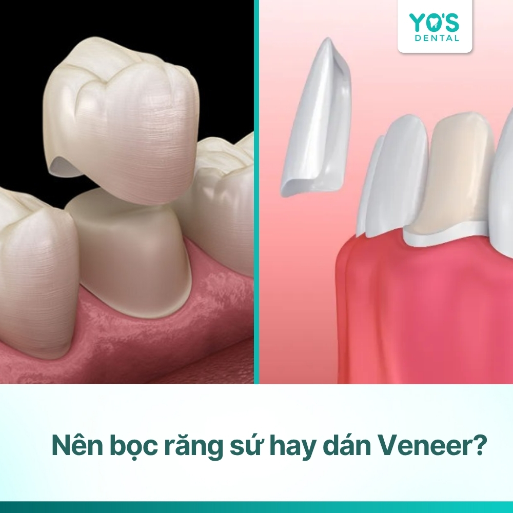 Nên bọc răng sứ hay dán veneer: Loại nào tốt hơn cho bạn?