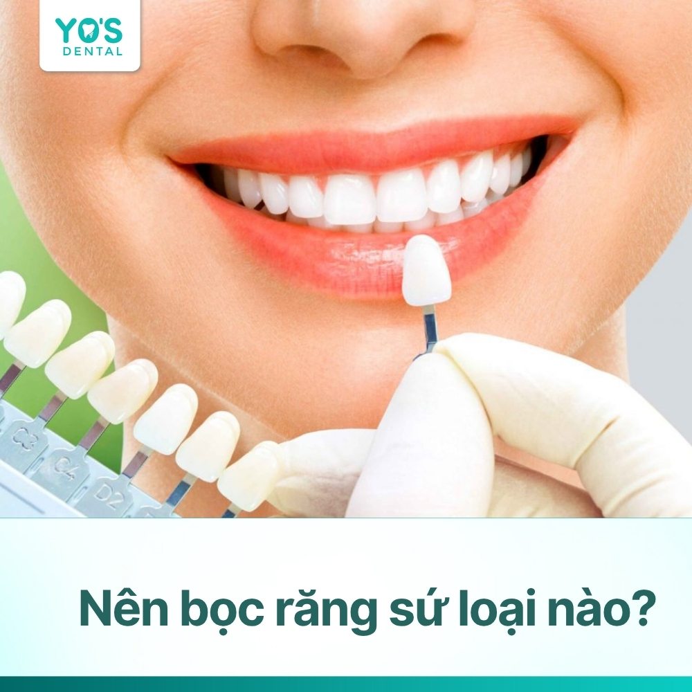 Nên bọc răng sứ loại nào? Khám phá các loại răng sứ, ưu nhược điểm