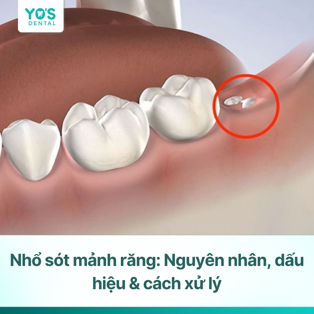 Nhổ sót mảnh răng: Nguyên nhân, dấu hiệu & cách xử lý