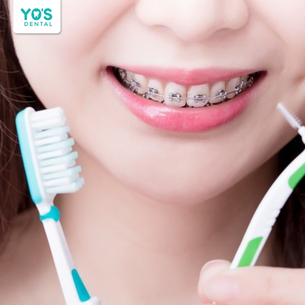 Vệ sinh răng miệng kỹ lưỡng giúp người niềng răng không bị viêm nướu hay sâu răng