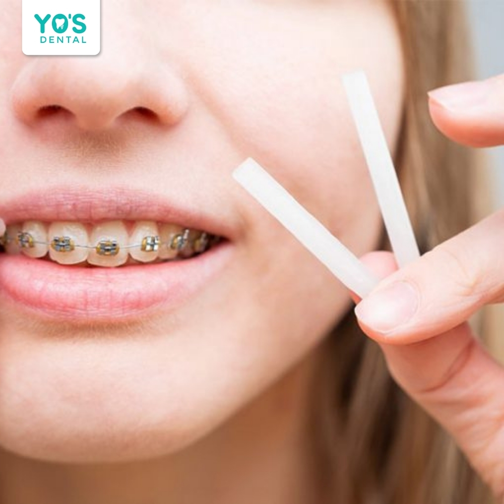 Bôi sáp nha khoa quanh mắc cài để tránh ma sát gây đau