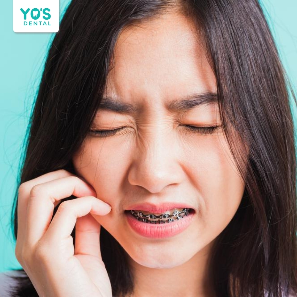 Giai đoạn đầu niềng răng thường ê buốt, vì vậy chế độ dinh dưỡng lúc này rất quan trọng