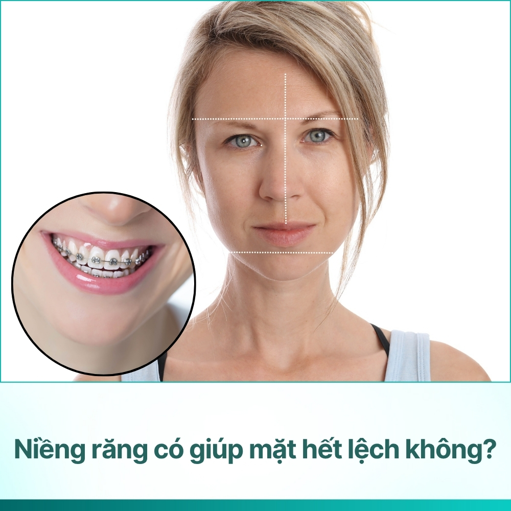 Niềng răng có giúp mặt hết lệch không? Hiểu đúng để điều trị