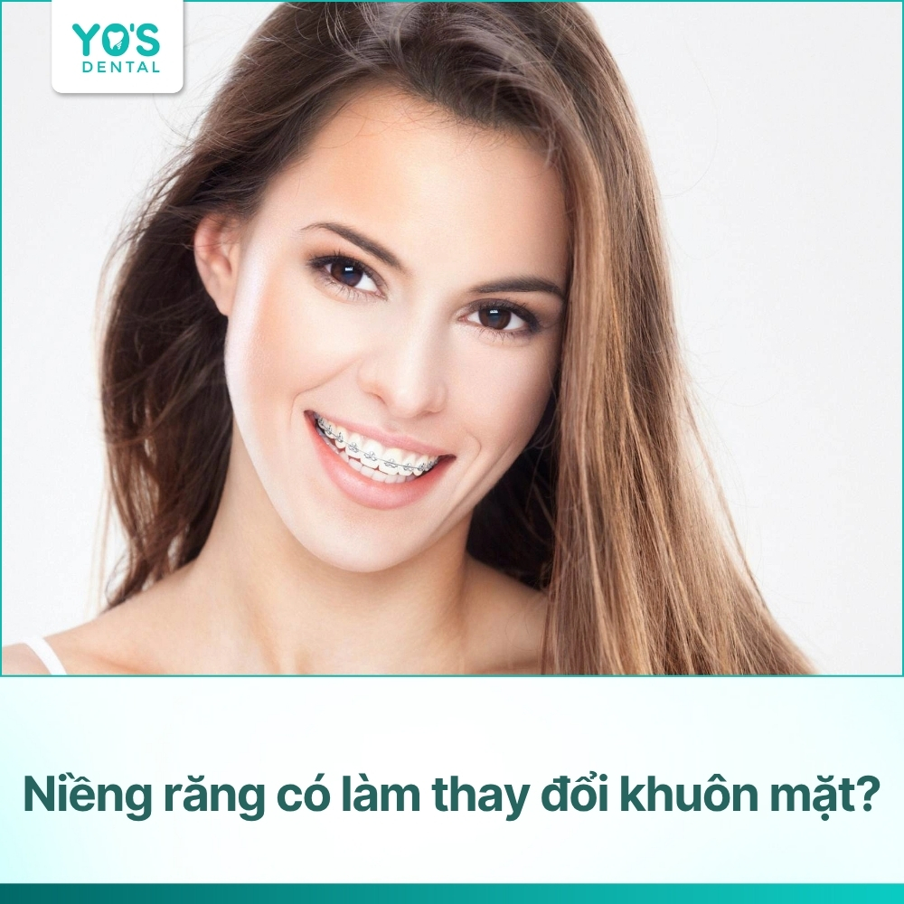 Niềng răng có làm thay đổi khuôn mặt? 6 thay đổi giúp mặt thon gọn