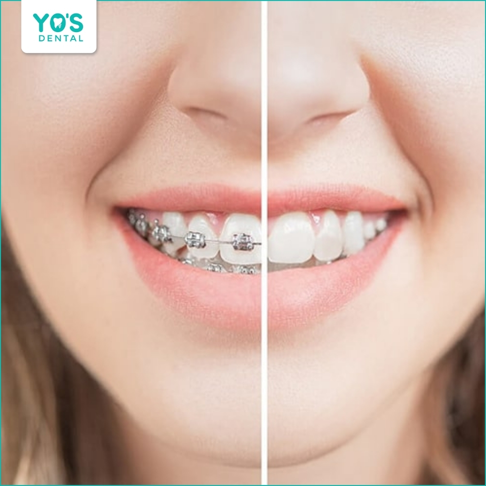 Niềng răng giúp cải thiện thẩm mỹ khuôn mặt, giúp nụ cười tự tin, rạng rỡ hơn