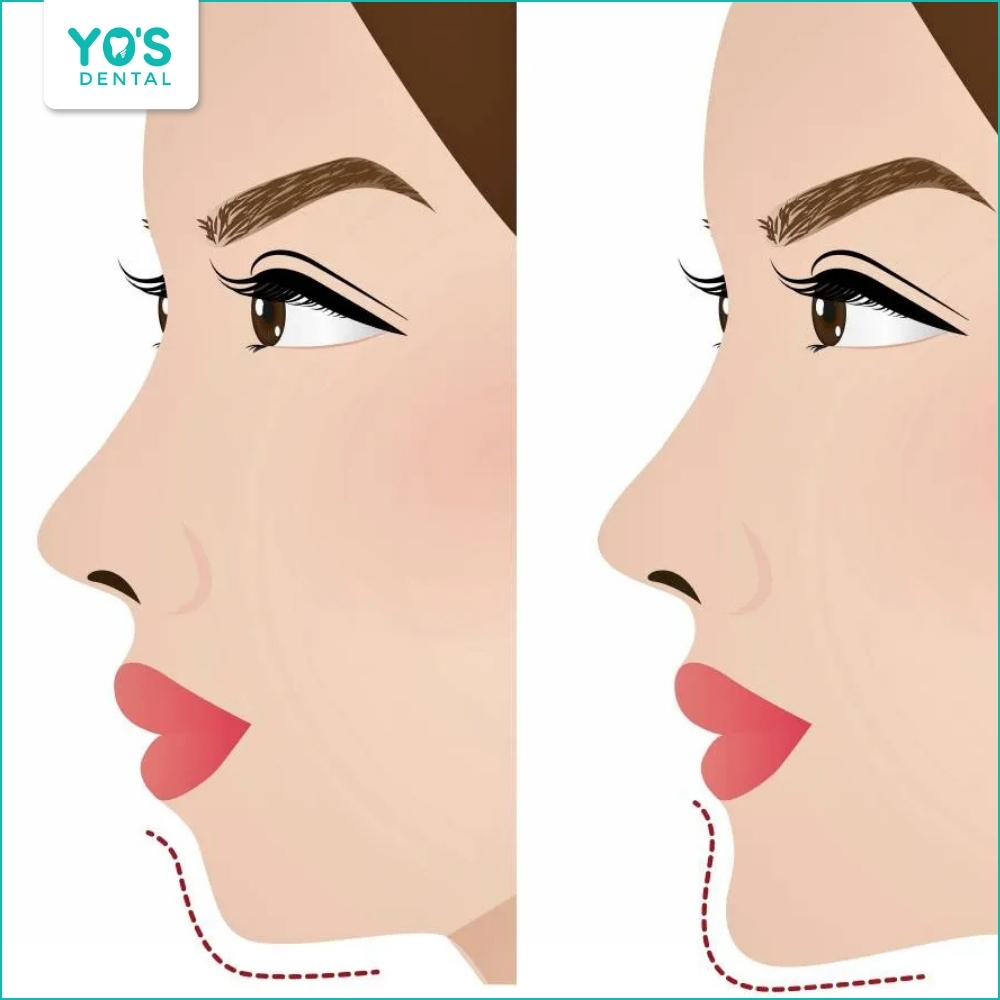 Niềng răng giúp góc nghiêng khuôn mặt thanh thoát, cân đối hơn