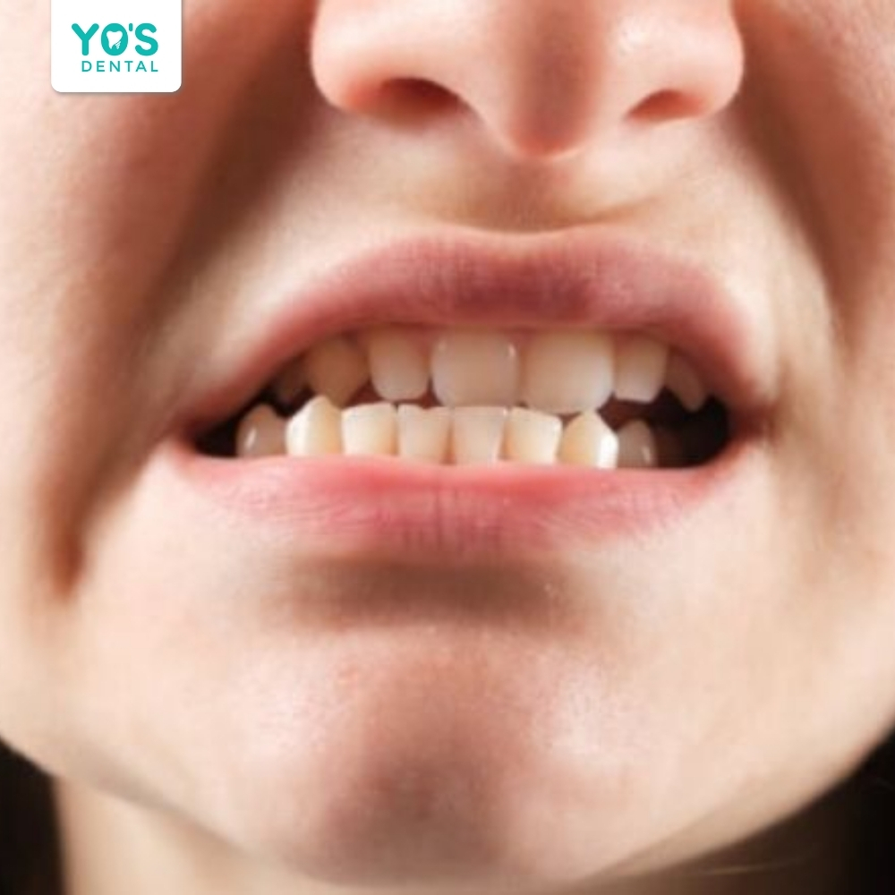 Khớp cắn ngược khiến răng hàm dưới chìa ra ngoài so với hàm trên