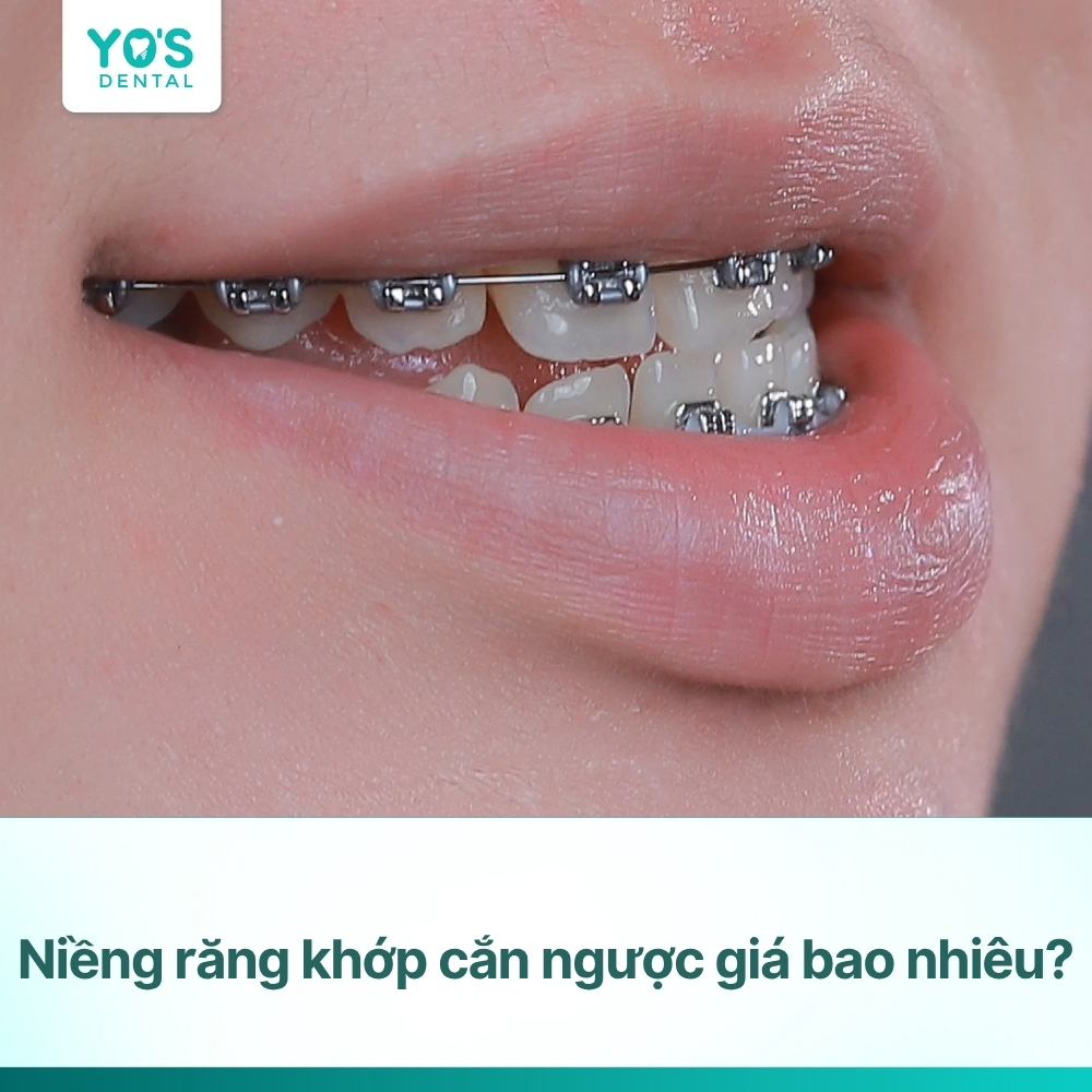 Niềng răng khớp cắn ngược giá bao nhiêu? Bảng giá mới nhất