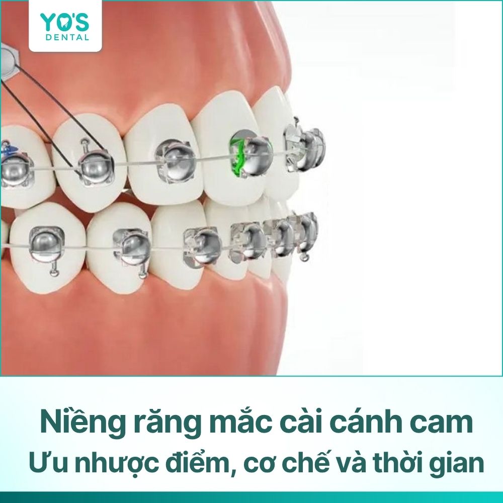 Niềng răng mắc cài cánh cam: Ưu nhược điểm, cơ chế và thời gian