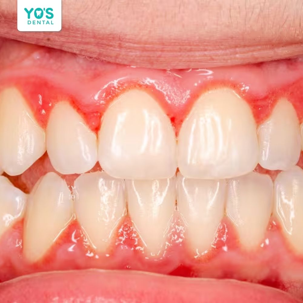 Nguy cơ viêm nướu hoặc kích ứng nướu nếu quá trình chăm sóc răng miệng khi niềng không đúng cách