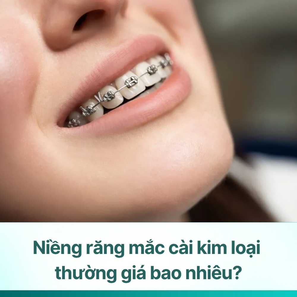 Niềng răng mắc cài kim loại thường giá bao nhiêu? Bảng giá mới nhất